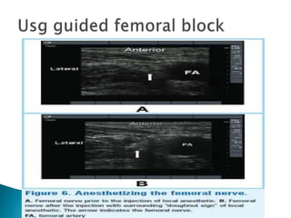 Peripheral nerve blocks