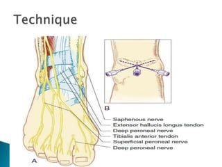 Peripheral nerve blocks