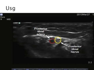 Peripheral nerve blocks