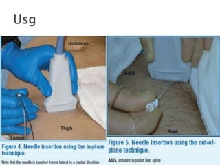 Peripheral nerve blocks