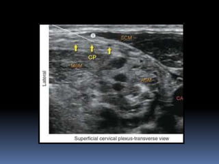 Peripheral nerve blocks | PPTX