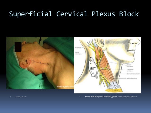 Superficial Cervical Plexus Block Ppt