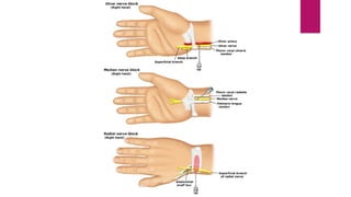 Triangular Nerve Block Patch Peripheral nerve blocks a detailed note. | PPTX