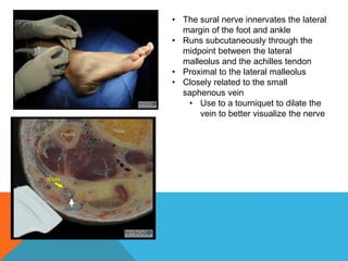 • The sural nerve innervates the lateral
margin of the foot and ankle
• Runs subcutaneously through the
midpoint between the lateral
malleolus and the achilles tendon
• Proximal to the lateral malleolus
• Closely related to the small
saphenous vein
• Use to a tourniquet to dilate the
vein to better visualize the nerve
 