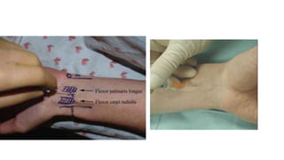 Peripheral Nerve Blocks of the Arm.pptx