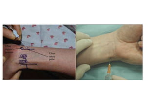 Peripheral Nerve Blocks of the Arm.pptx