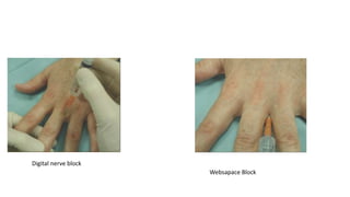 Peripheral Nerve Blocks of the Arm.pptx