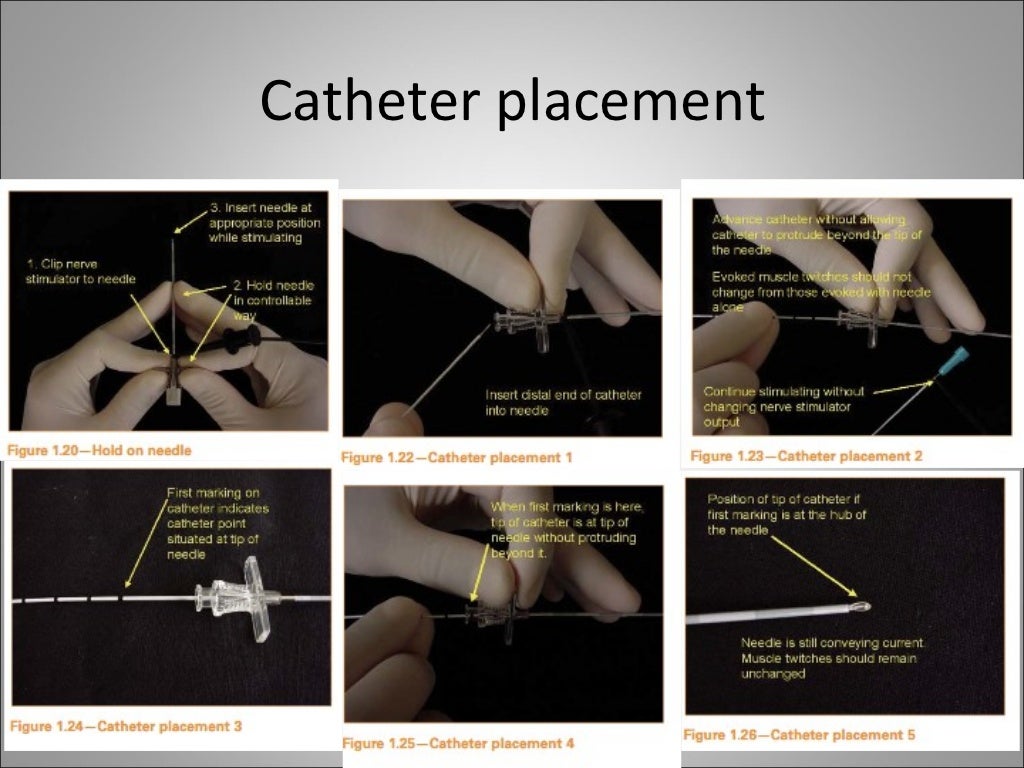 Peripheral Nerve Catheters