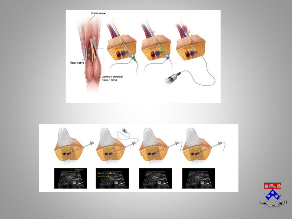 Peripheral Nerve Catheters