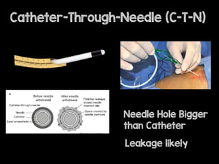Sono
Theco
ultraso
Catheter-Through-Needle (C-T-N)
Needle Hole Bigger
than Catheter
Leakage likely
 