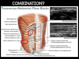 Regional Anesthesia and Pain Medicine • Volume 42, Number 2, March-Ap
COMBINATION?
 