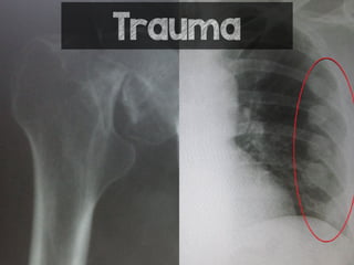 Trauma
 