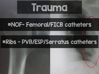Trauma
#NOF- Femoral/FICB catheters
#Ribs - PVB/ESP/Serratus catheters
 