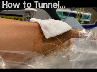 How to Tunnel?
How to Tunnel…
 