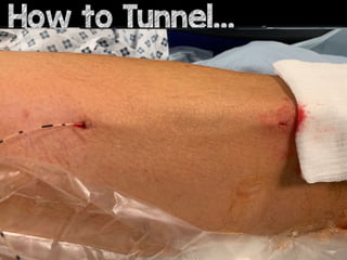 How to Tunnel?
How to Tunnel…
 