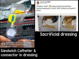 Sandwich Catheter &
connector in dressing
Sacrificial dressing
 