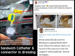 Sandwich Catheter &
connector in dressing
Sacrificial dressing
 