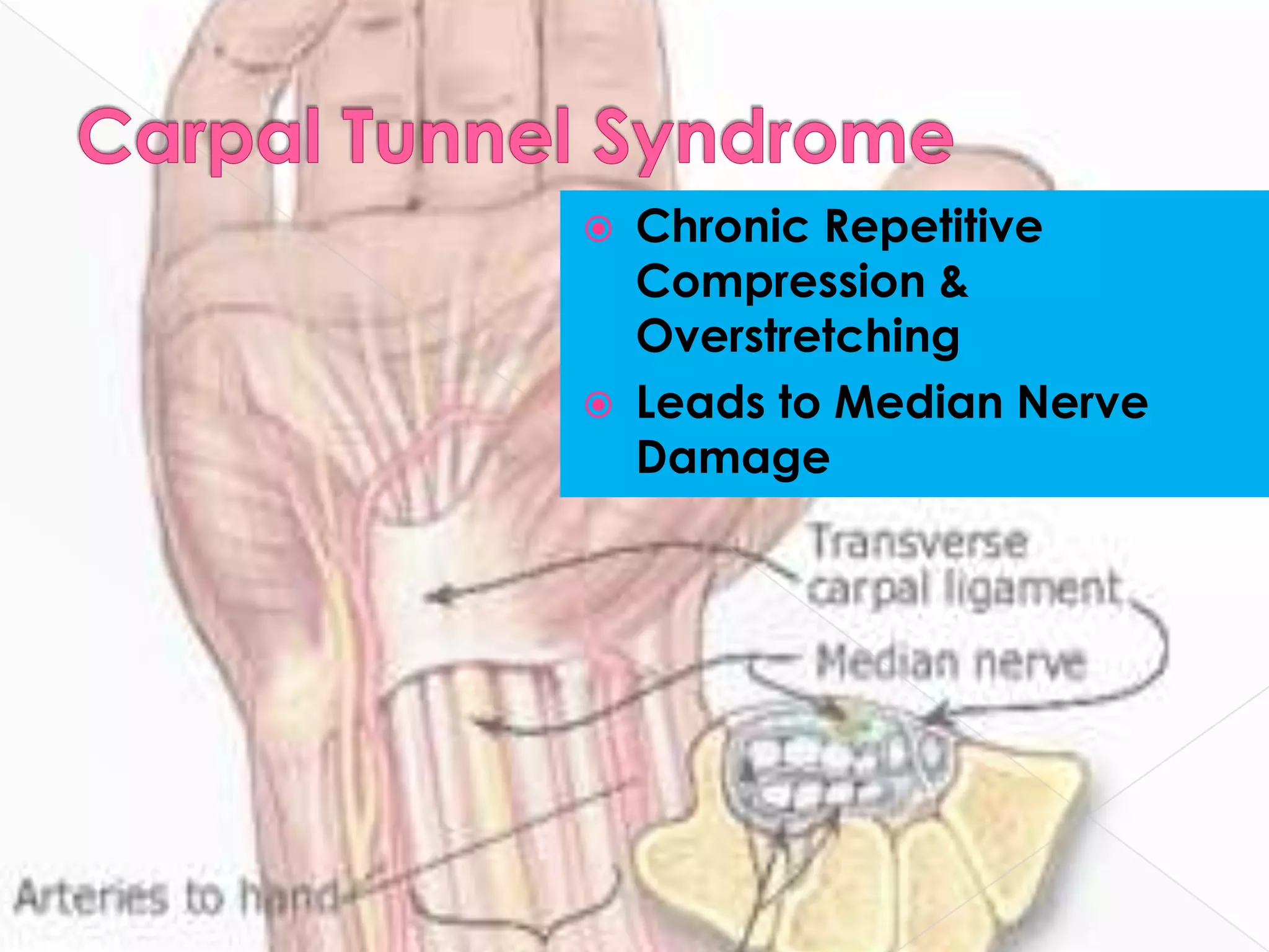 Carpal Tunnel SyndromeChronic Repetitive Compression & OverstretchingLeads to Median Nerve Damage