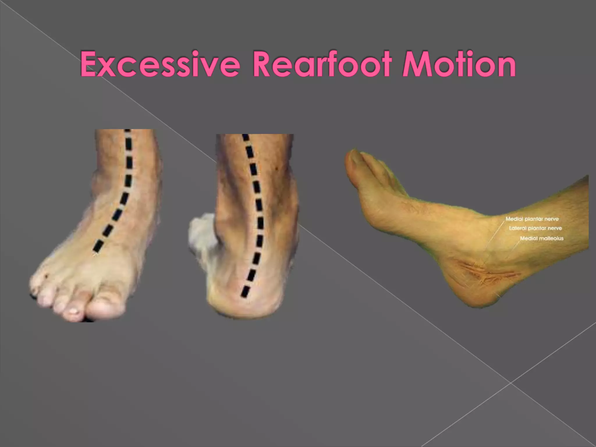 Excessive Rearfoot Motion