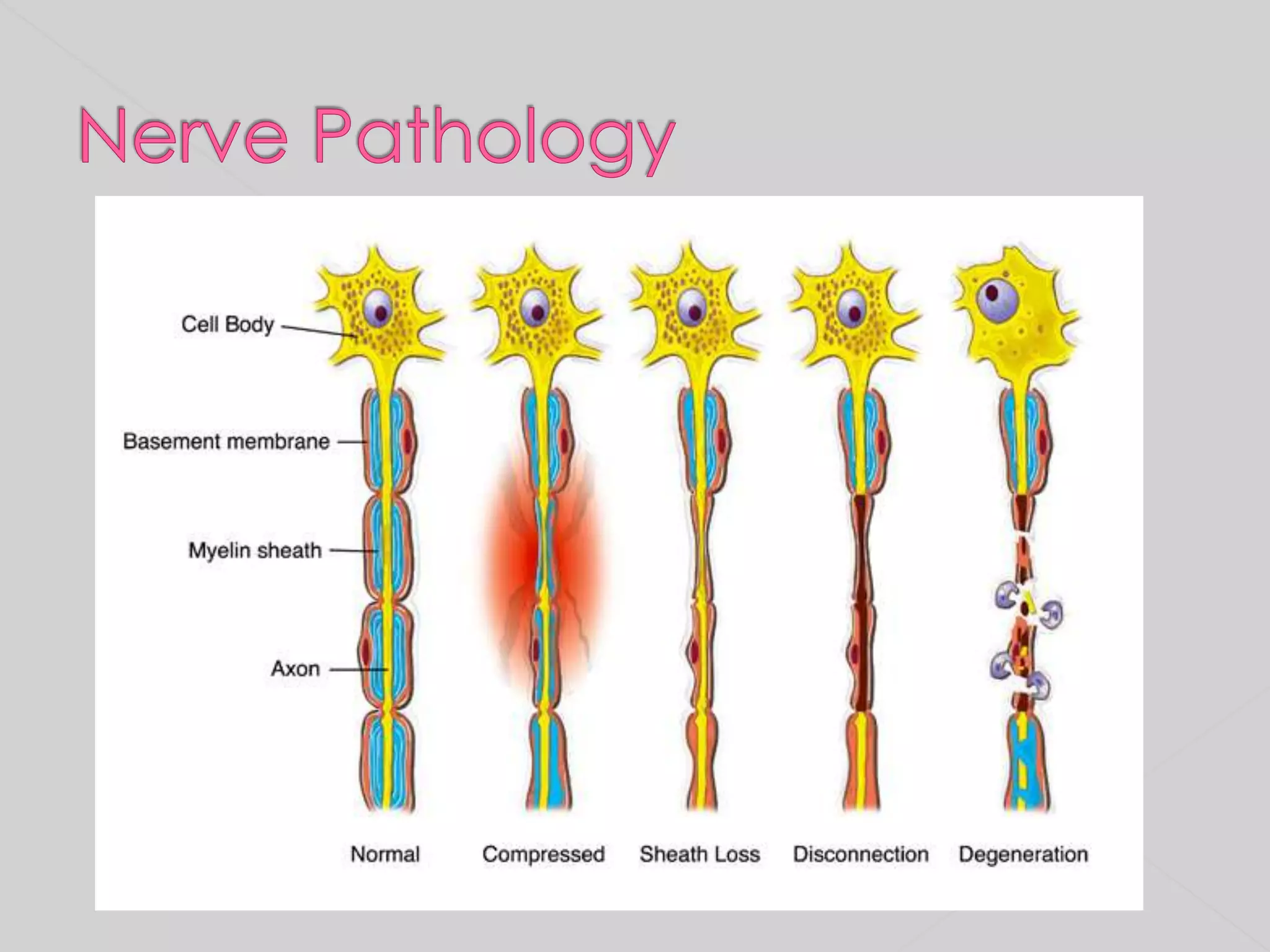 Nerve Pathology