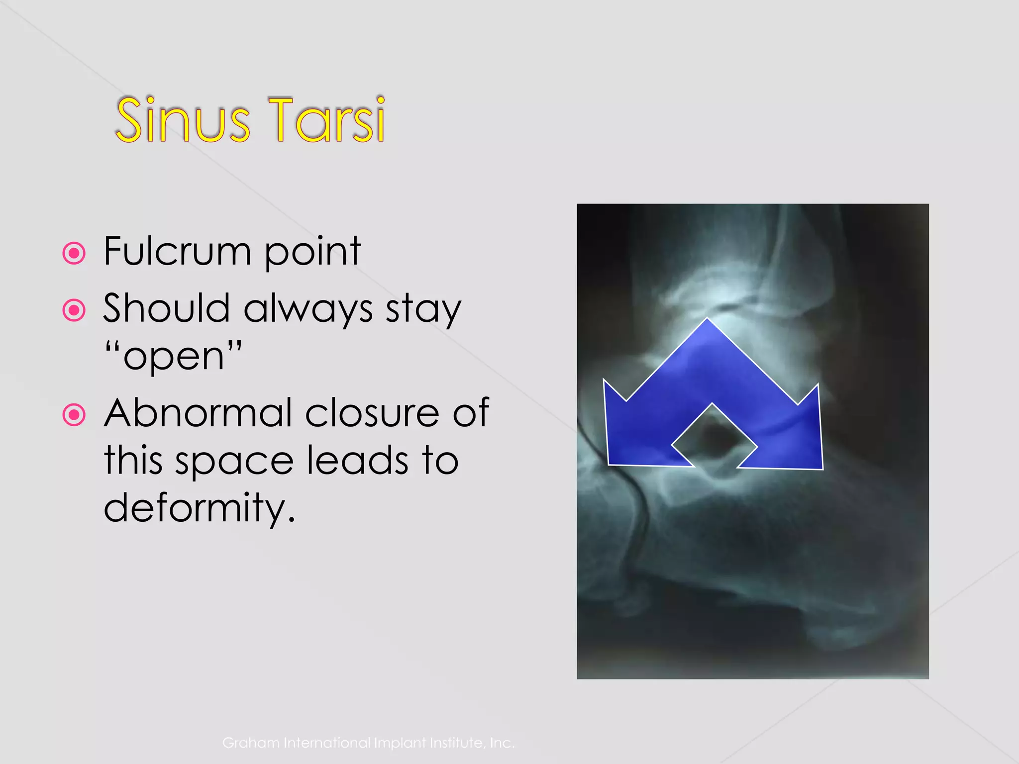Graham International Implant Institute, Inc.Sinus TarsiFulcrum point Should always stay “open”Abnormal closure of this space leads to deformity.