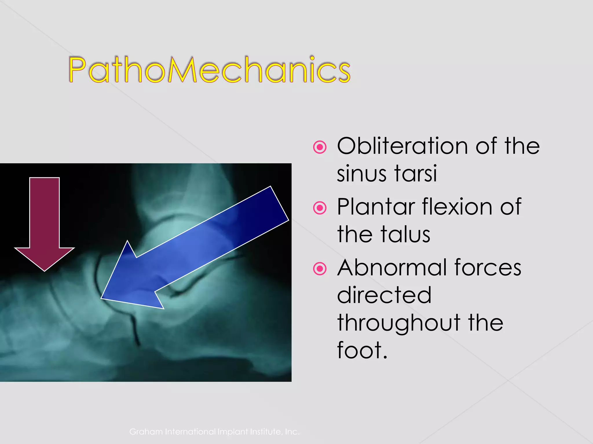 Graham International Implant Institute, Inc.PathoMechanicsObliteration of the sinus tarsiPlantar flexion of the talusAbnormal forces directed throughout the foot.