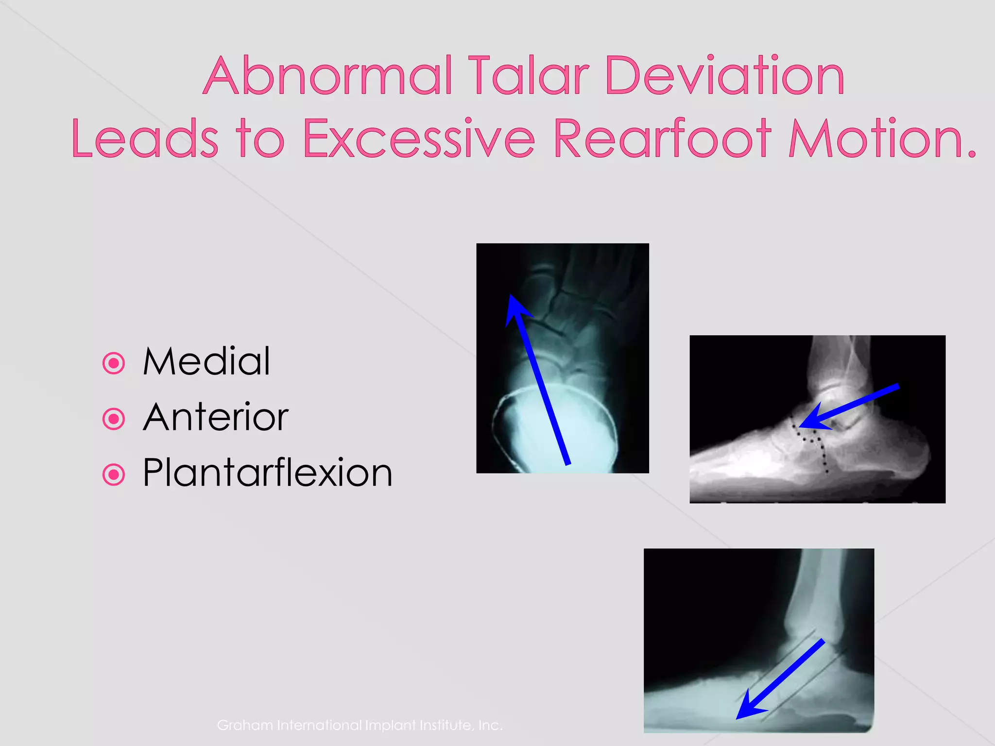 Graham International Implant Institute, Inc.Abnormal Talar DeviationLeads to Excessive Rearfoot Motion.MedialAnteriorPlantarflexion