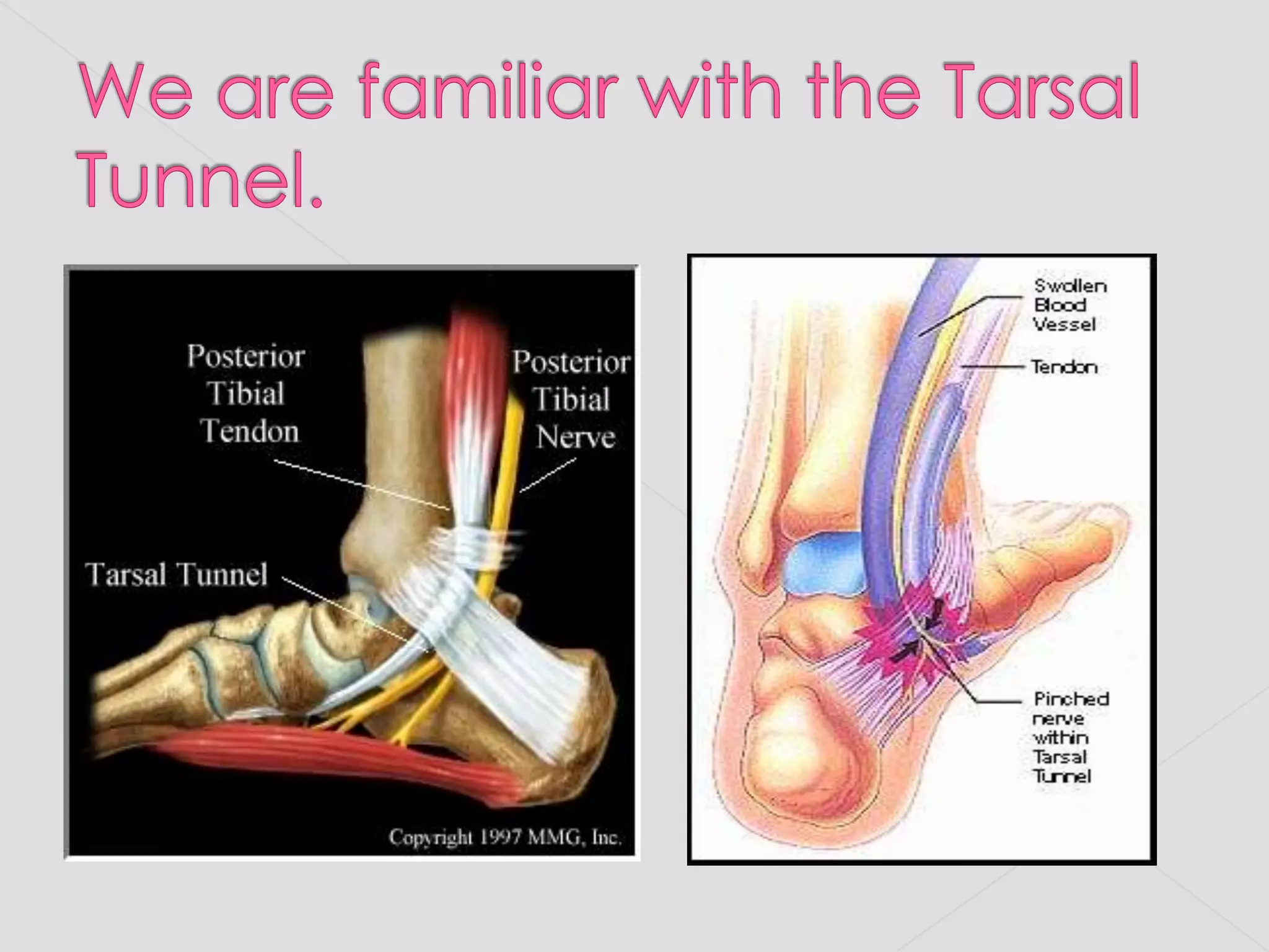 We are familiar with the Tarsal Tunnel.   
