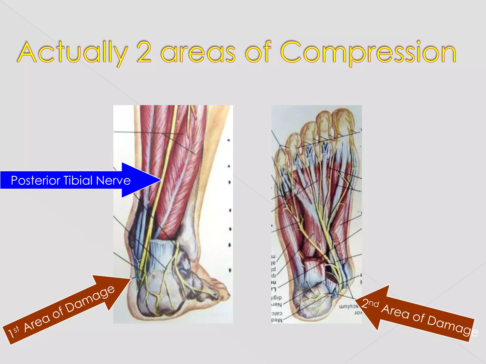 Actually 2 areas of CompressionPosterior Tibial Nerve1st Area of Damage2nd Area of Damage