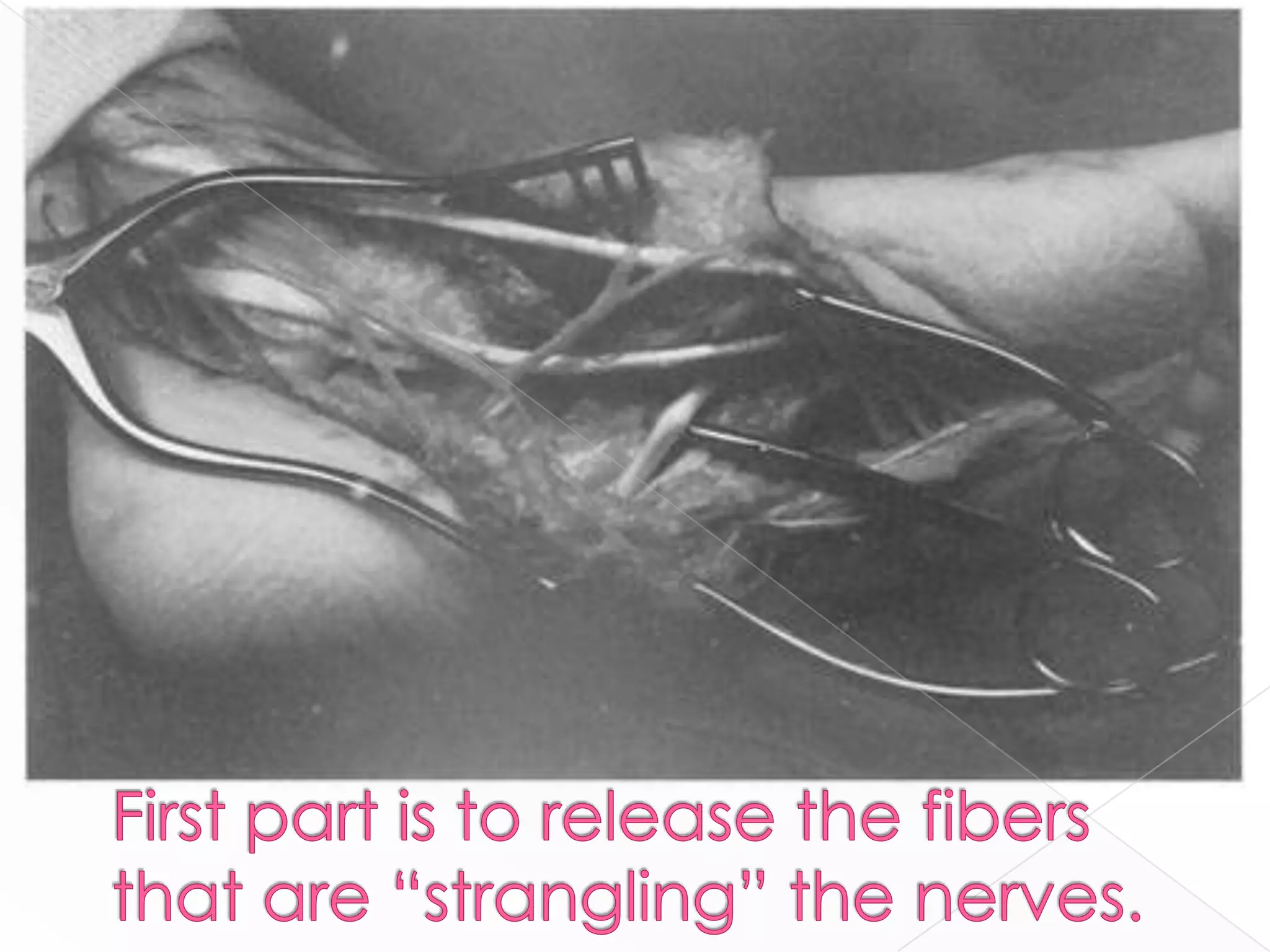 First part is to release the fibers that are “strangling” the nerves.