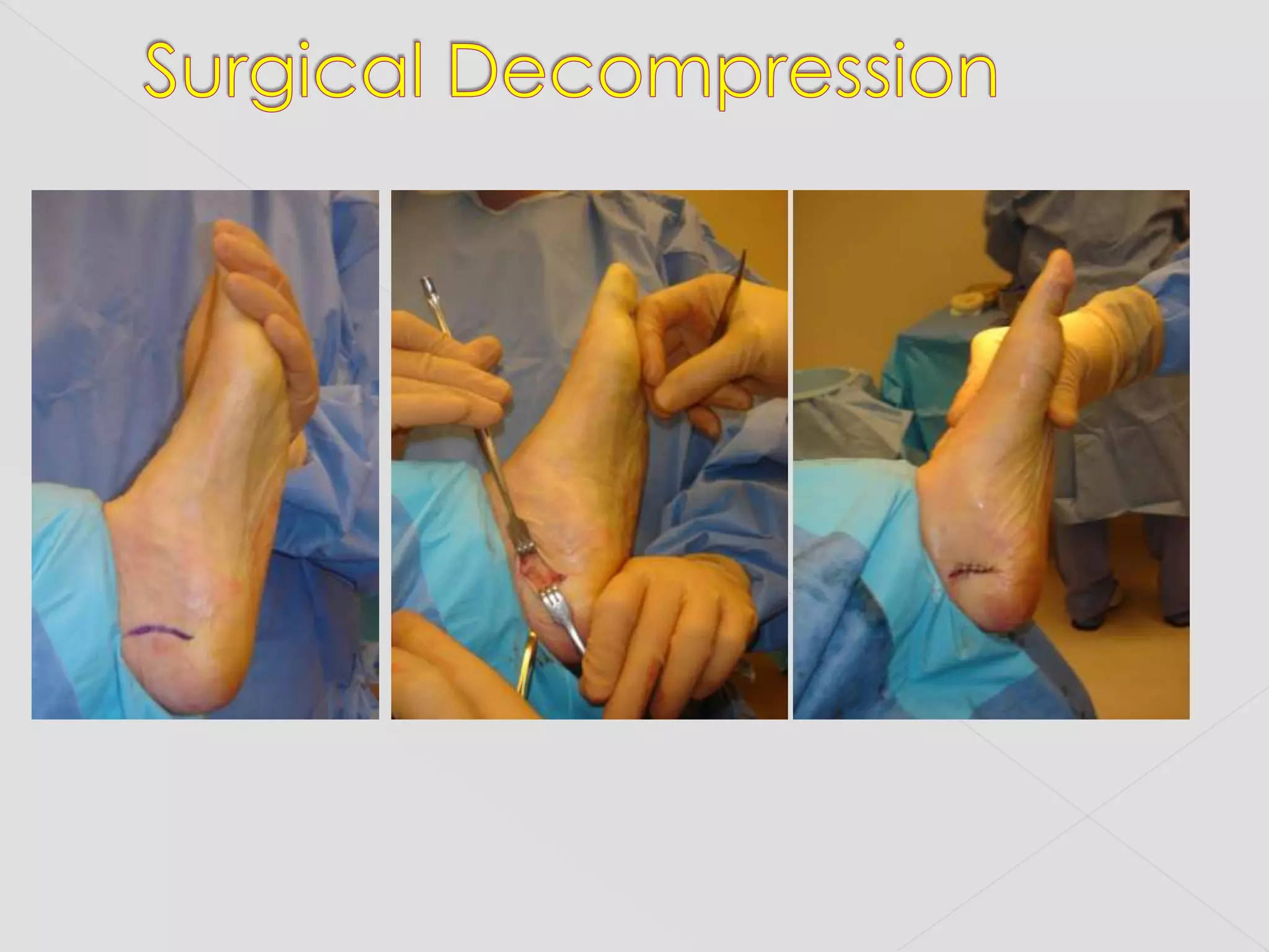 Surgical Decompression