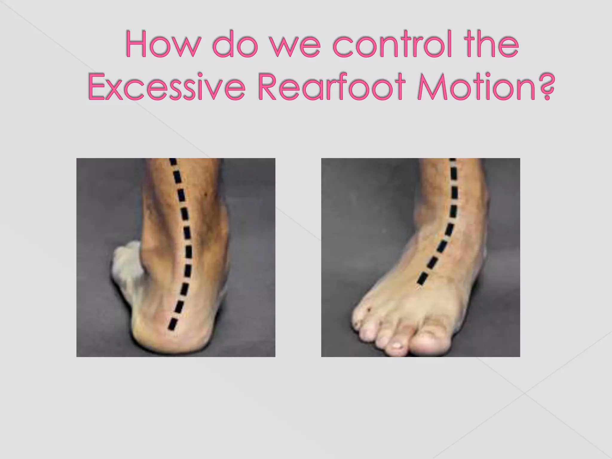 How do we control the Excessive Rearfoot Motion?