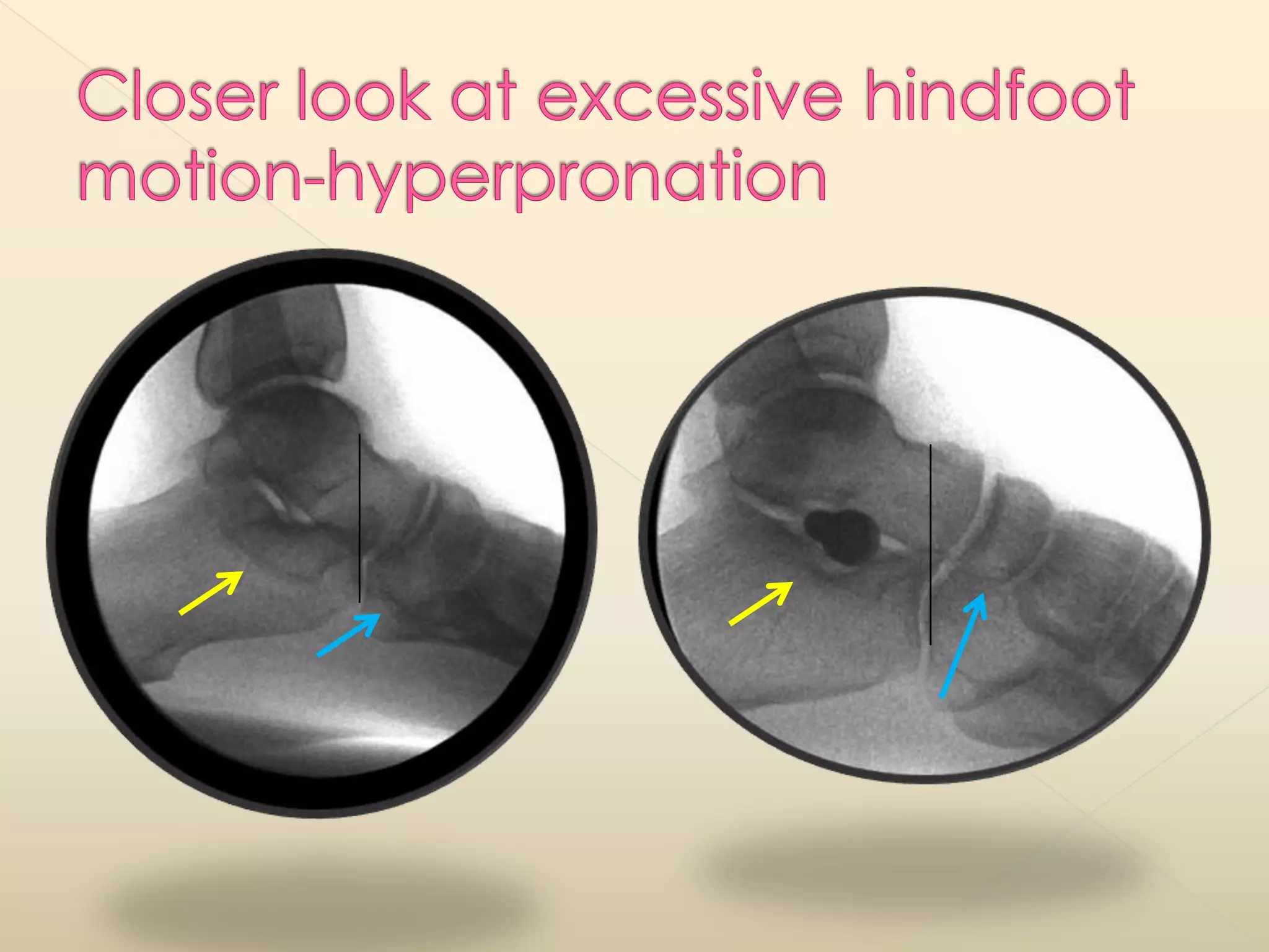 Closer look at excessive hindfoot motion-hyperpronation