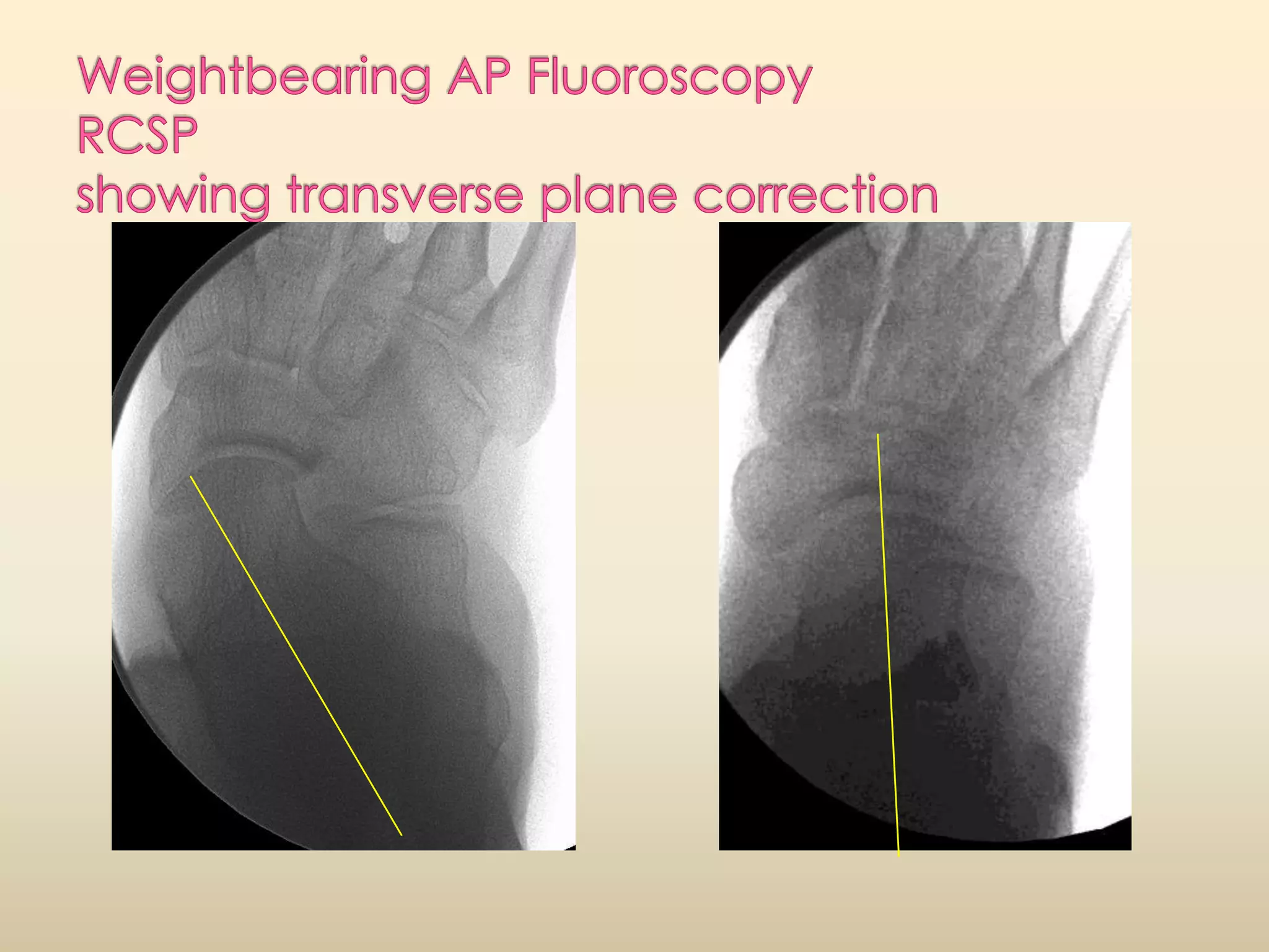Weightbearing AP FluoroscopyRCSP showing transverse plane correction