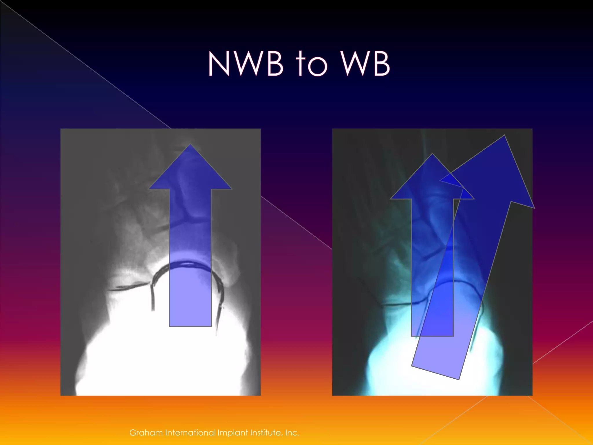 Graham International Implant Institute, Inc.NWB to WB