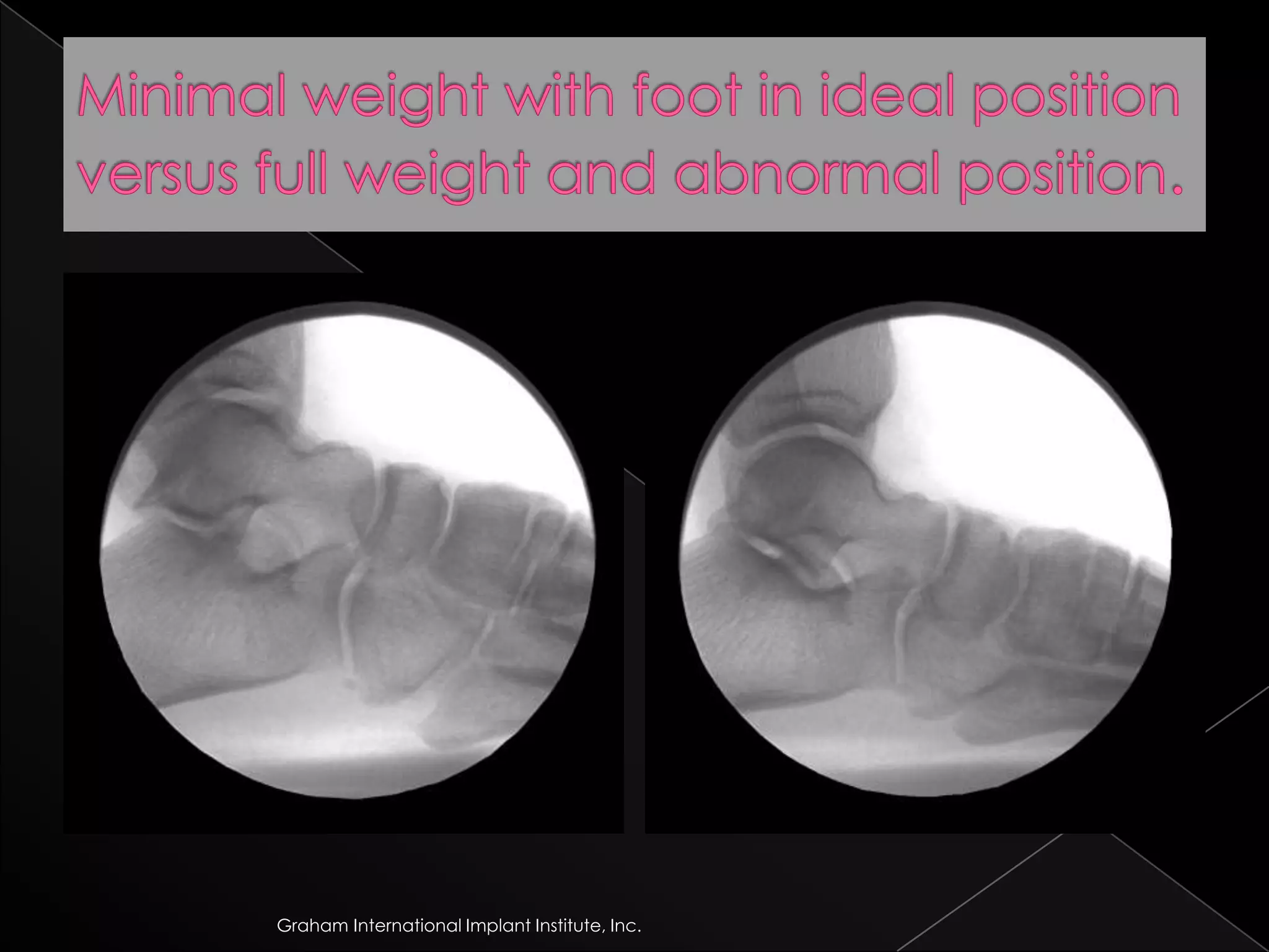 Minimal weight with foot in ideal position versus full weight and abnormal position.Graham International Implant Institute, Inc.