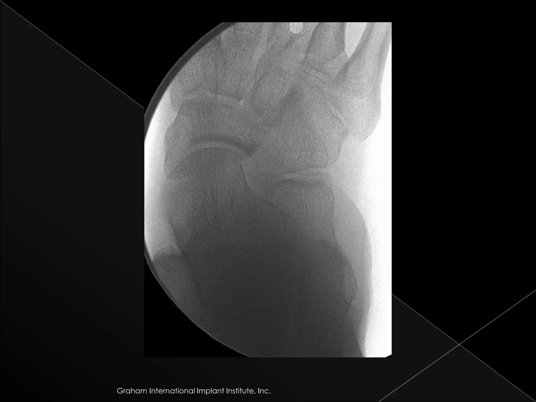 Graham International Implant Institute, Inc.