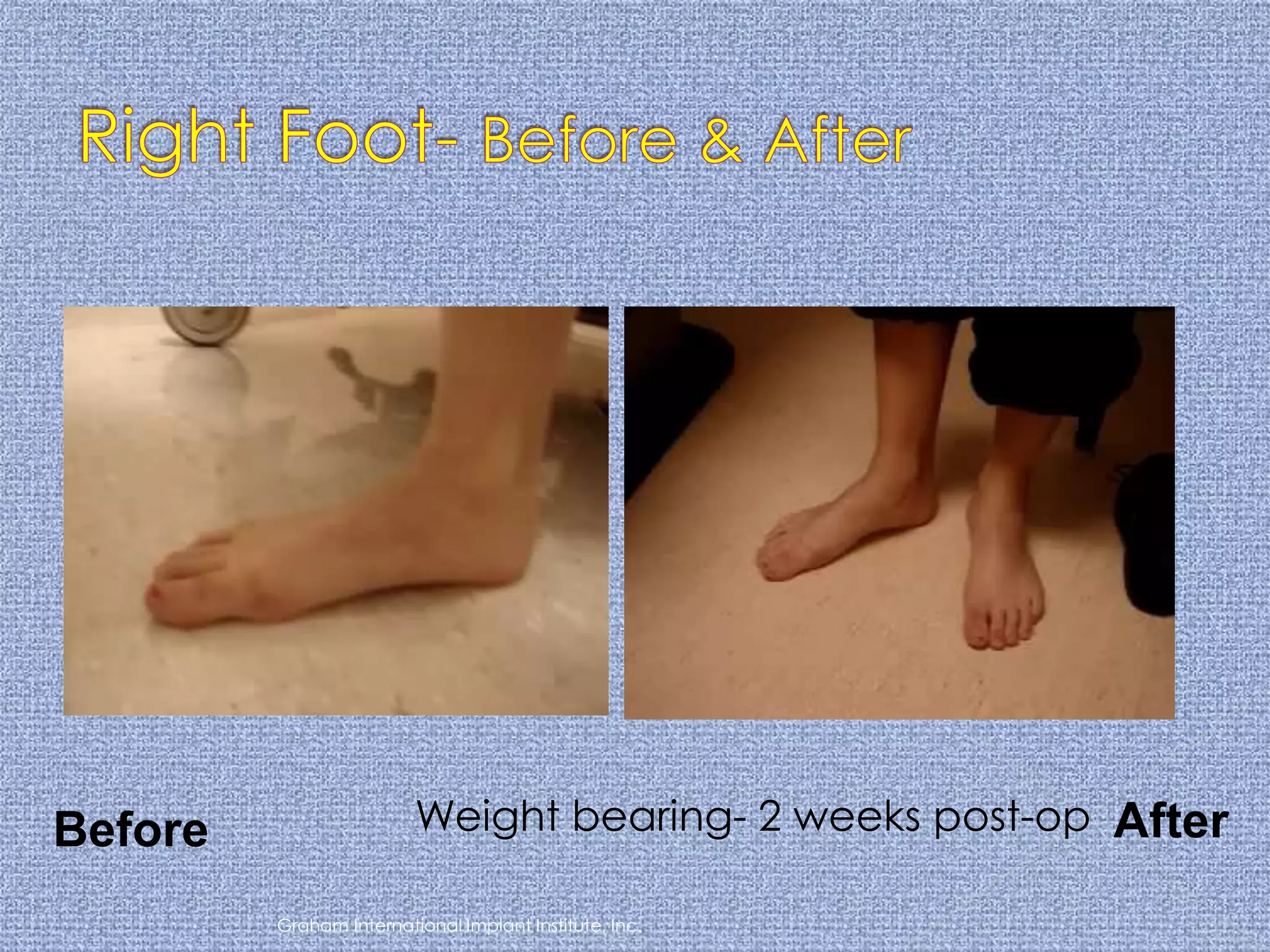 Graham International Implant Institute, Inc.Right Foot- Before & AfterWeight bearing- 2 weeks post-opAfterBefore