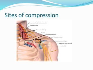 Sites of compression
 