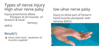Types of nerve injury
High ulnar nerve palsy low ulnar nerve palsy
Injury proximal to elbow
Paralysis of all muscles of
forearm & hand
Sensory
deficit
Result(1)
● Ulnar claw hand - weakness of
muscles supplied
Injury to distal part of forearm
hand muscles paralysed with
sensory deficit
 