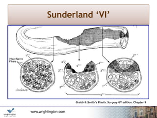 www.wrightington.com
Sunderland ‘VI’
Grabb & Smith’s Plastic Surgery 6th edition. Chapter 9
 