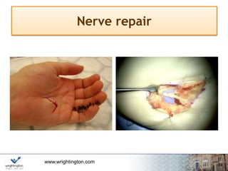www.wrightington.com
Nerve repair
 