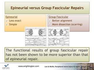 www.wrightington.com
Epineurial versus Group Fascicular Repairs
Epineurial
Less exact
Simple
Group Fascicular
Better alignment
More dissection (scarring)
The functional results of group fascicular repair
has not been shown to be more superior than that
of epineurial repair.
Lee & Wolfe. Peripheral nerve injury & repair. JAAOS 2000
 