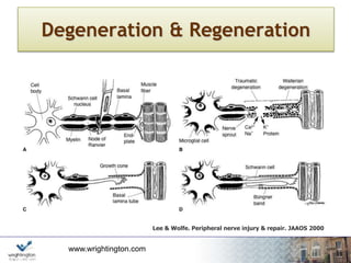 www.wrightington.com
Degeneration & Regeneration
Lee & Wolfe. Peripheral nerve injury & repair. JAAOS 2000
 