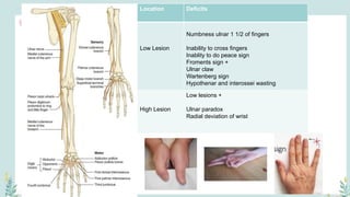 ULNAR NERVE
Location Deficits
Low Lesion
Numbness ulnar 1 1/2 of fingers
Inability to cross fingers
Inablity to do peace sign
Froments sign +
Ulnar claw
Wartenberg sign
Hypothenar and interossei wasting
High Lesion
Low lesions +
Ulnar paradox
Radial deviation of wrist
 