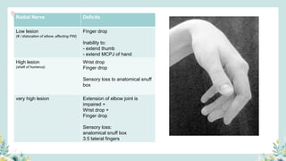 Radial Nerve Deficits
Low lesion
(# / dislocation of elbow, affecting PIN)
Finger drop
Inability to:
- extend thumb
- extend MCPJ of hand
High lesion
(shaft of humerus)
Wrist drop
Finger drop
Sensory loss to anatomical snuff
box
very high lesion Extension of elbow joint is
impaired +
Wrist drop +
Finger drop
Sensory loss:
anatomical snuff box
3.5 lateral fingers
 
