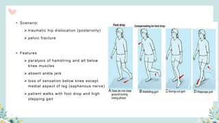 • Scenario:
 traumatic hip dislocation (posteriorly)
 pelvic fracture
• Features
 paralysis of hamstring and all below
knee muscles
 absent ankle jerk
 loss of sensation below knee except
medial aspect of leg (saphenous nerve)
 patient walks with foot drop and high
stepping gait
 