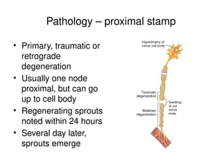 Pathology – proximal stamp
• Primary, traumatic or
retrograde
degeneration
• Usually one node
proximal, but can go
up to cell body
• Regenerating sprouts
noted within 24 hours
• Several day later,
sprouts emerge
 