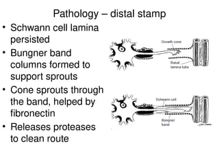 Pathology – distal stamp
• Schwann cell lamina
persisted
• Bungner band
columns formed to
support sprouts
• Cone sprouts through
the band, helped by
fibronectin
• Releases proteases
to clean route
 