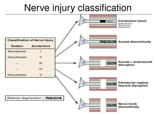 Nerve injury classification
 